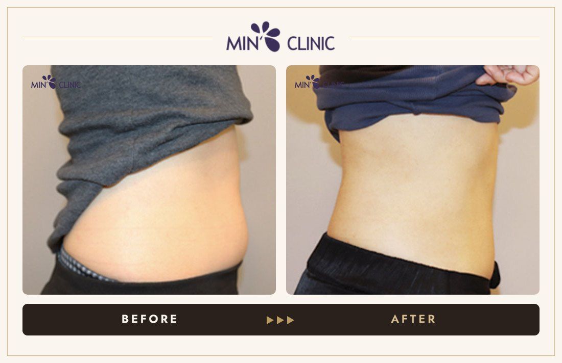 Abdomen Quick Slim before and after, case 8 – MIN Clinic Seoul
