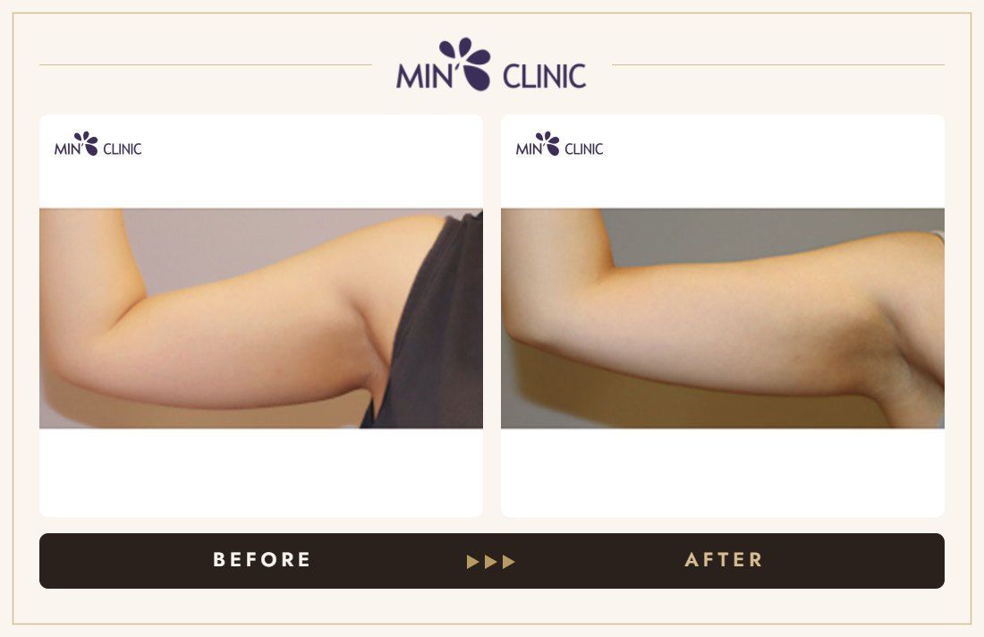 Arm Quick Slim before and after, case 28 – MIN Clinic Seoul