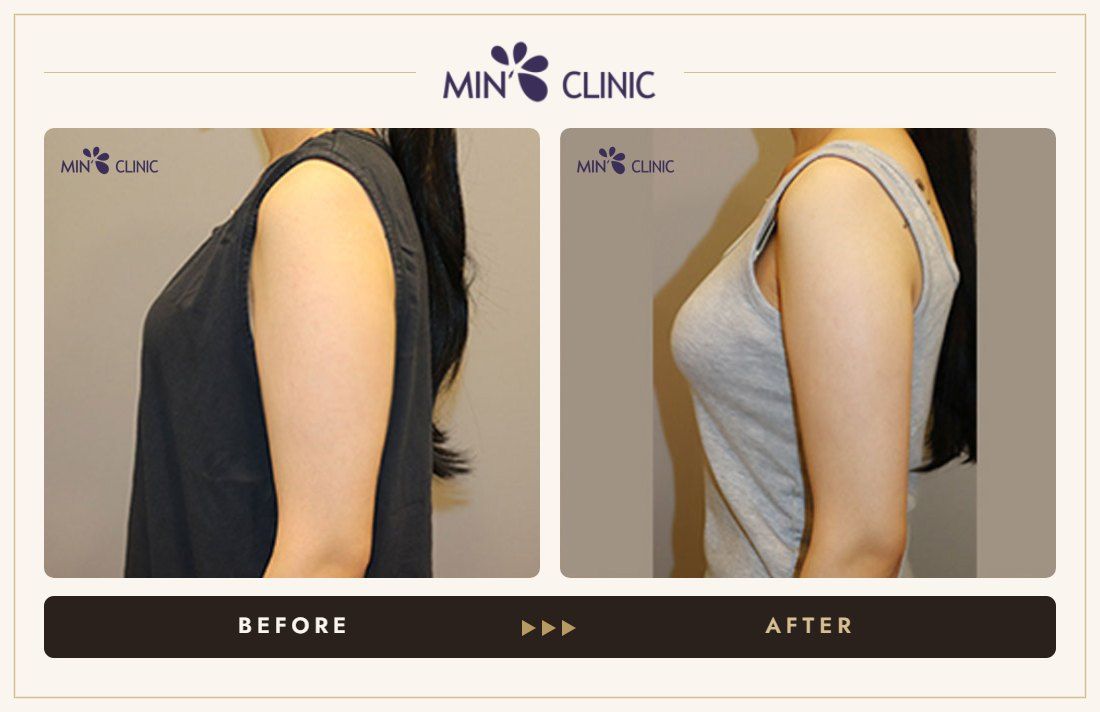 Arm Quick Slim before and after, case 29 – MIN Clinic Seoul