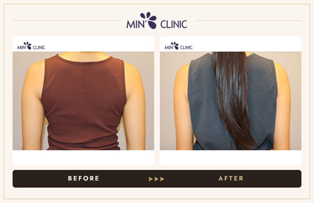 Arm Quick Slim before and after, case 30 – MIN Clinic Seoul