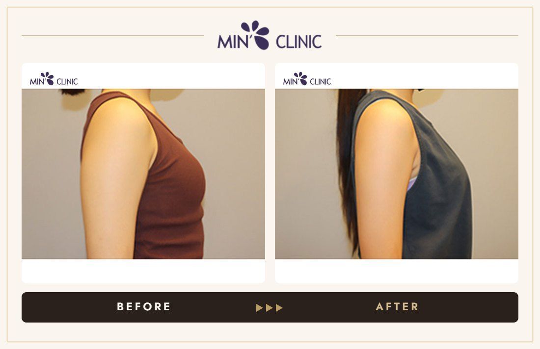 Arm Quick Slim before and after, case 31 – MIN Clinic Seoul