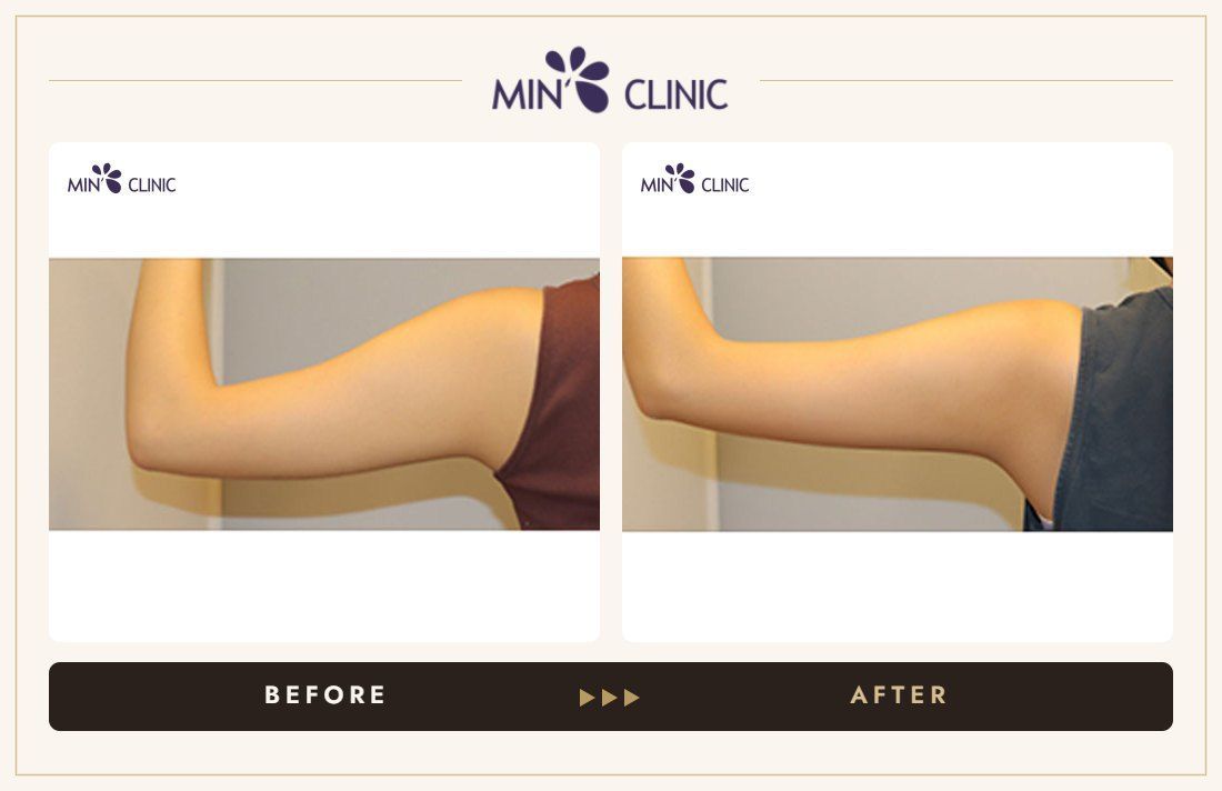 Arm Quick Slim before and after, case 32 – MIN Clinic Seoul