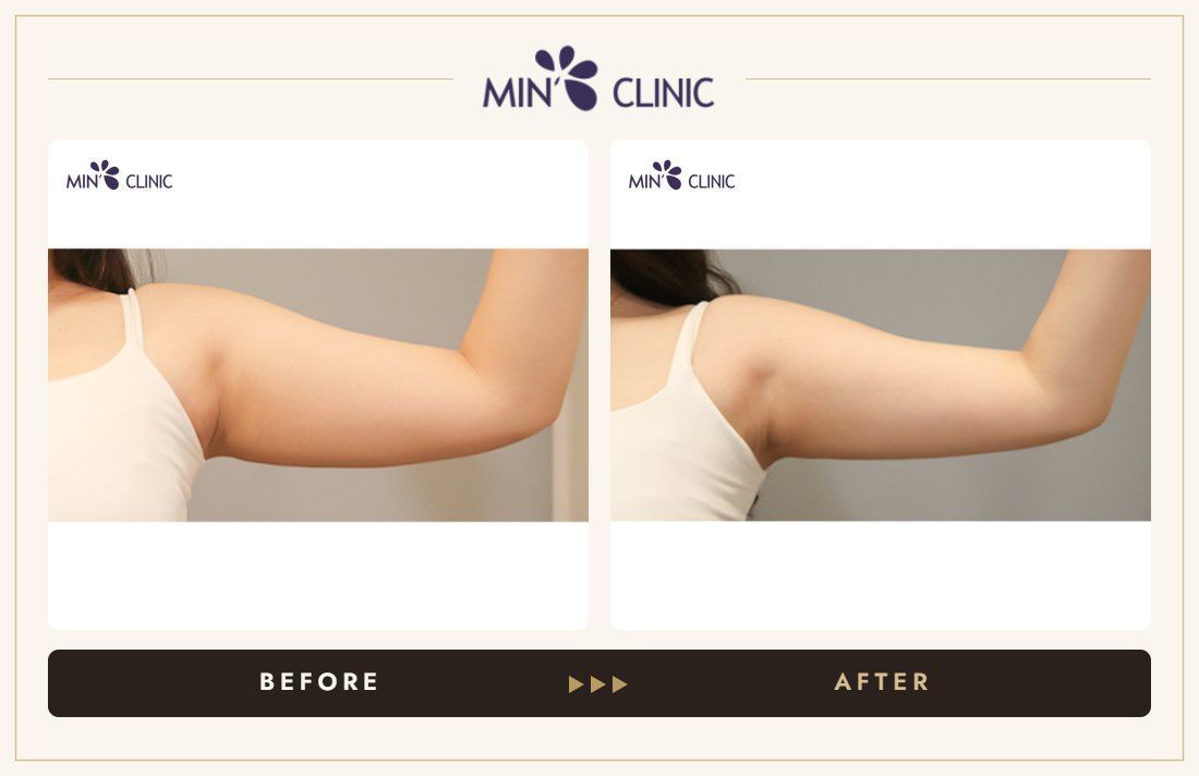 Arm ONDA lifting before and after, case 5 – MIN Clinic Seoul