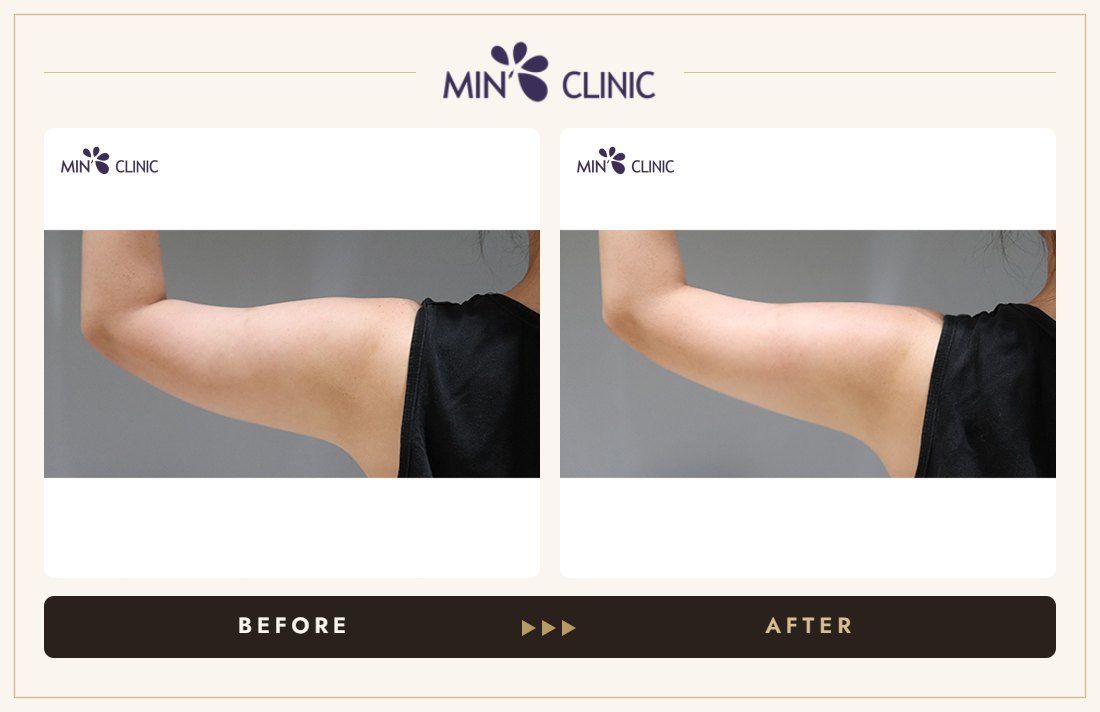 Arm ONDA lifting before and after, case 6 – MIN Clinic Seoul