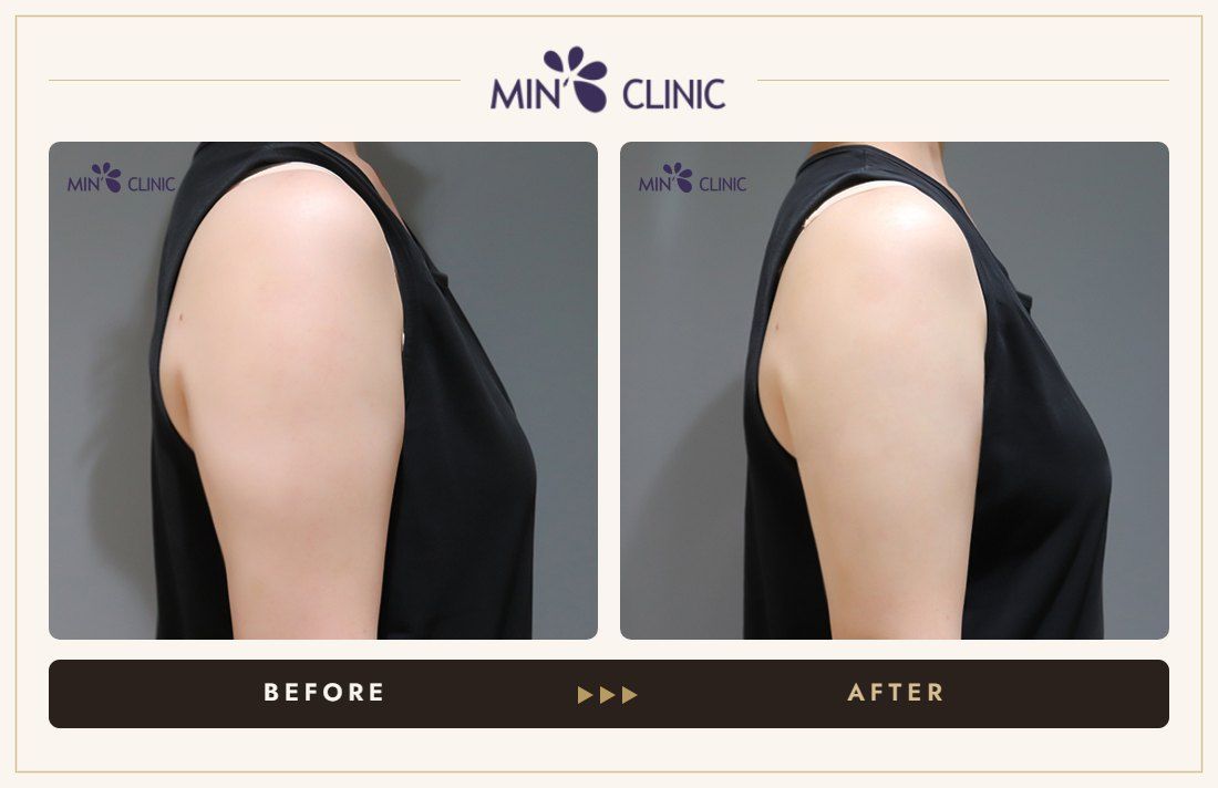 Arm ONDA lifting before and after, case 7 – MIN Clinic Seoul