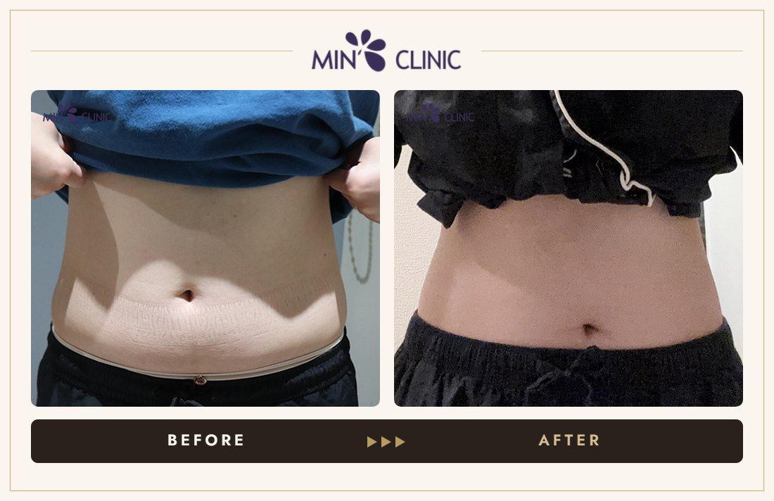 Abdomen ONDA lifting before and after, case 1 – MIN Clinic Seoul