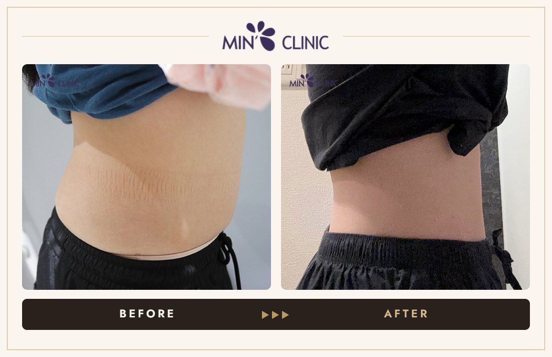 Abdomen ONDA lifting before and after, case 2 – MIN Clinic Seoul