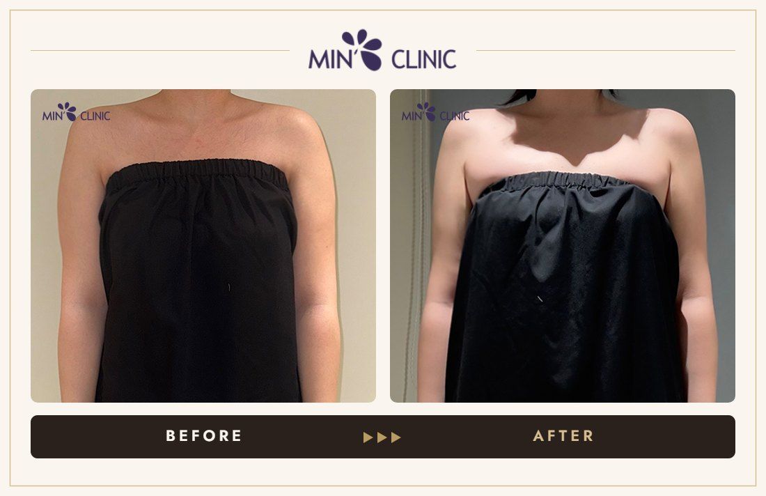 Arm ONDA lifting before and after, case 8 – MIN Clinic Seoul
