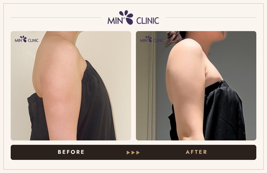 Arm ONDA lifting before and after, case 9 – MIN Clinic Seoul