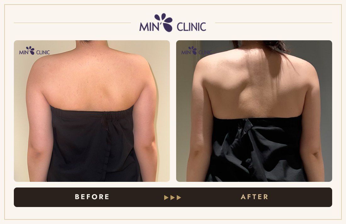 Arm ONDA lifting before and after, case 10 – MIN Clinic Seoul