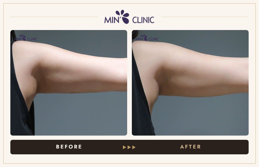 Arm ONDA lifting before and after, case 11 – MIN Clinic Seoul