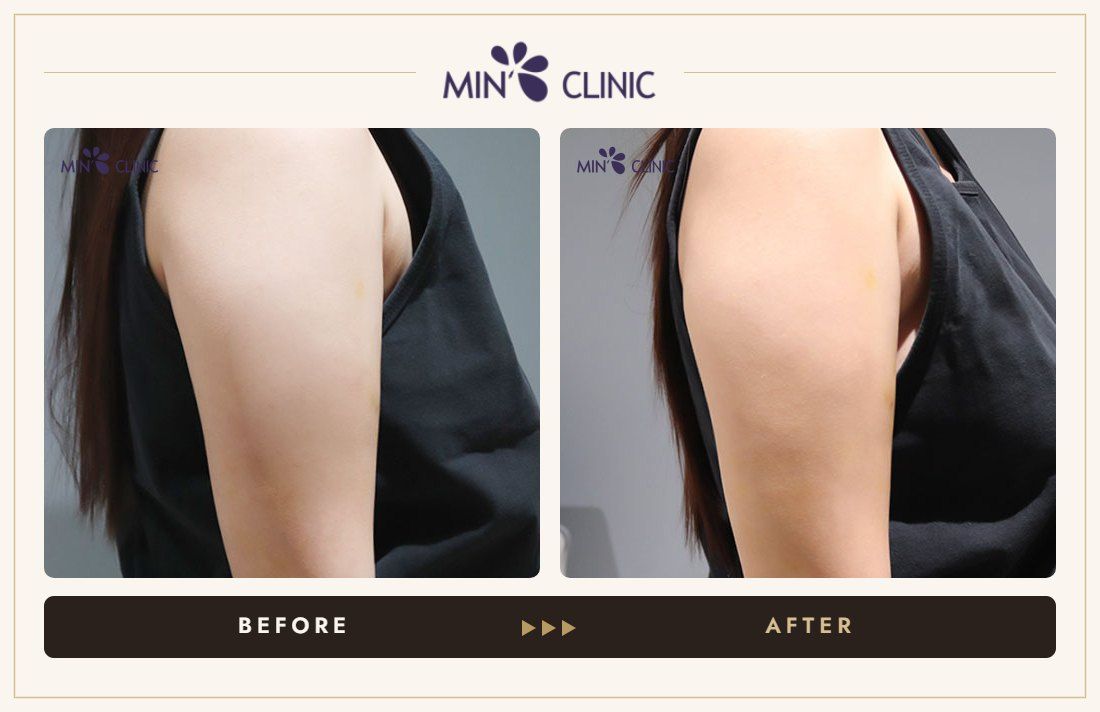 Arm ONDA lifting before and after, case 12 – MIN Clinic Seoul