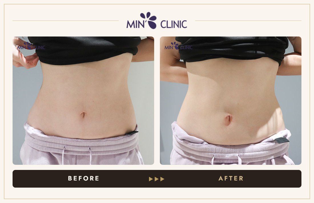 Abdomen ONDA lifting before and after, case 3 – MIN Clinic Seoul
