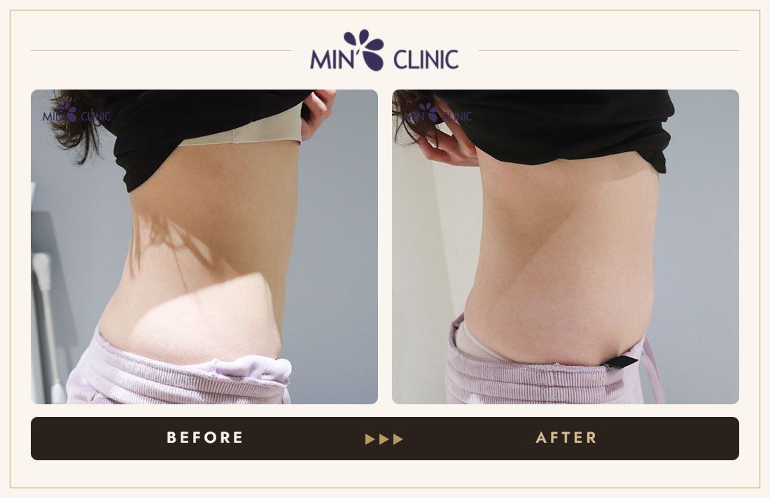 Abdomen ONDA lifting before and after, case 4 – MIN Clinic Seoul