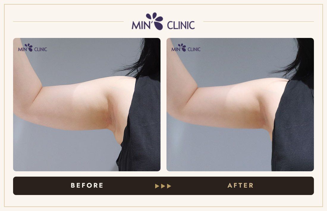 Arm Quick Slim before and after, case 33 – MIN Clinic Seoul
