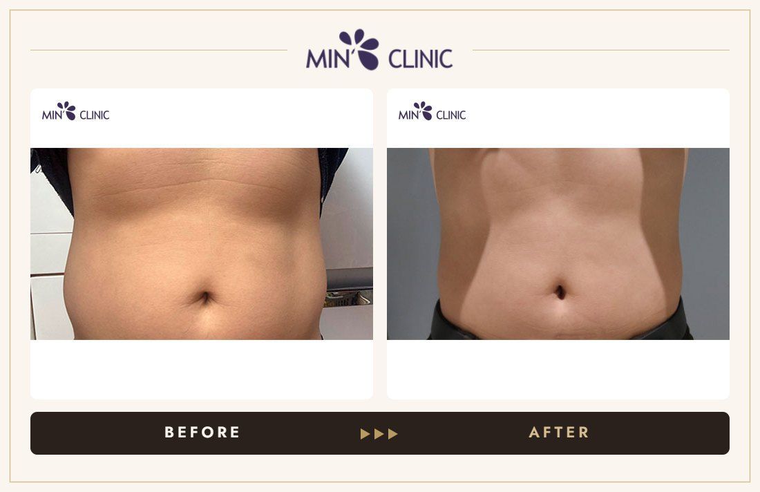 Abdomen Quick Slim before and after, case 9 – MIN Clinic Seoul