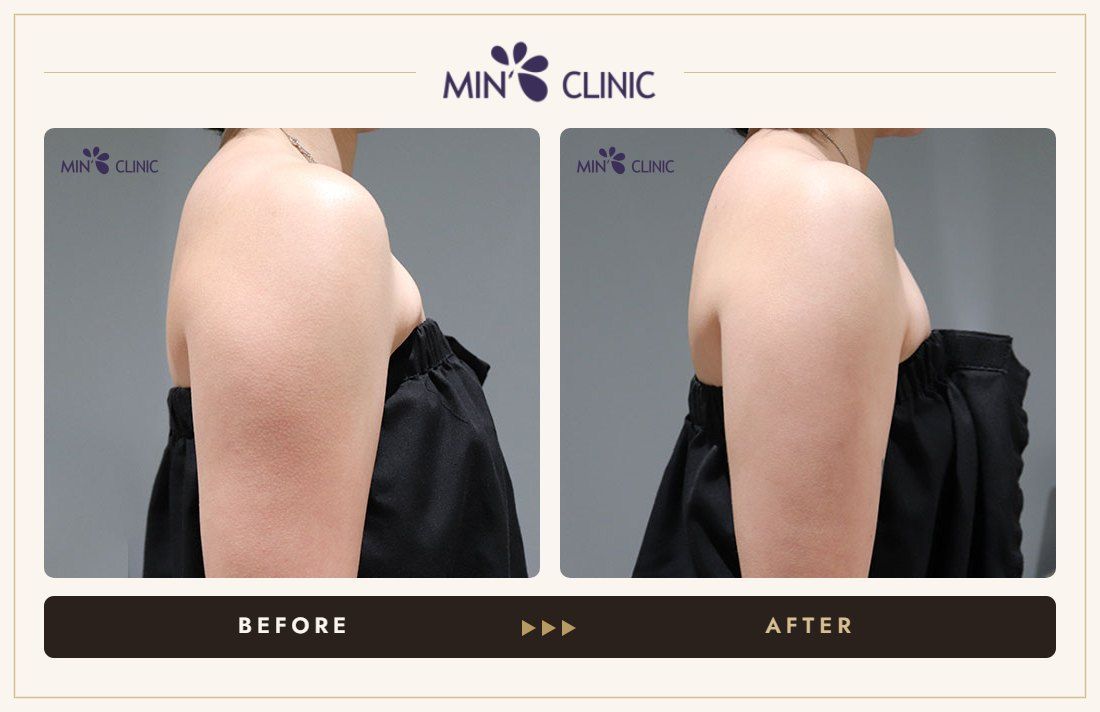 Body contouring before and after – MIN Clinic Gangnam, Seoul