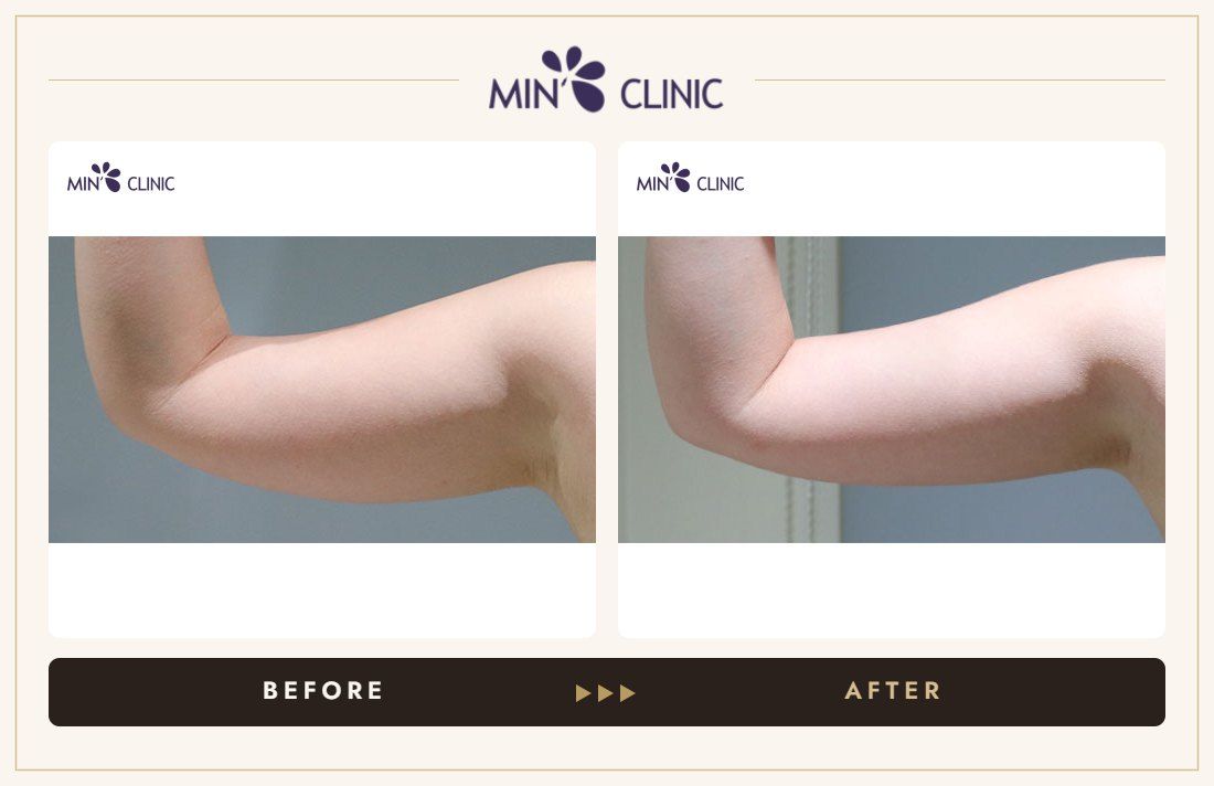 Body fat-dissolving injection before and after – MIN Clinic Gangnam, Seoul