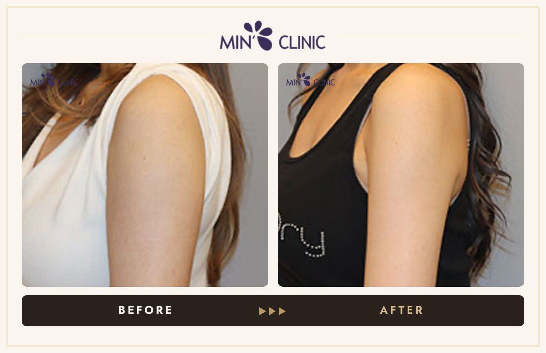 Arm Quick Slim before and after, case 10 – MIN Clinic Seoul