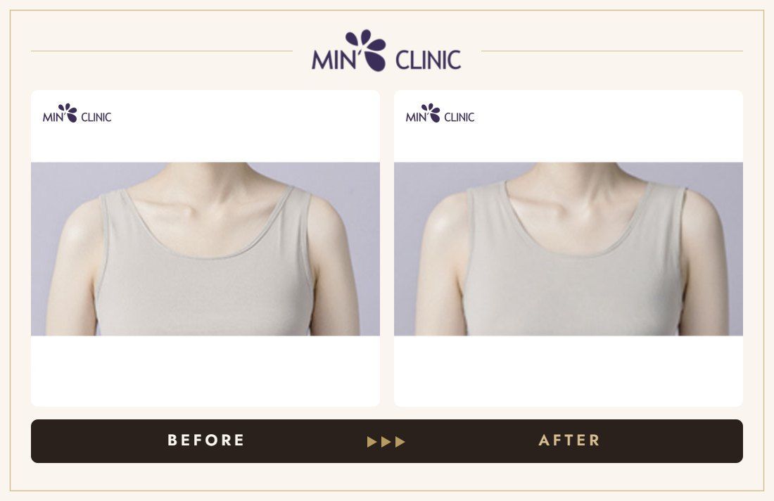 Shoulder filler before and after, case 1 – MIN Clinic Seoul