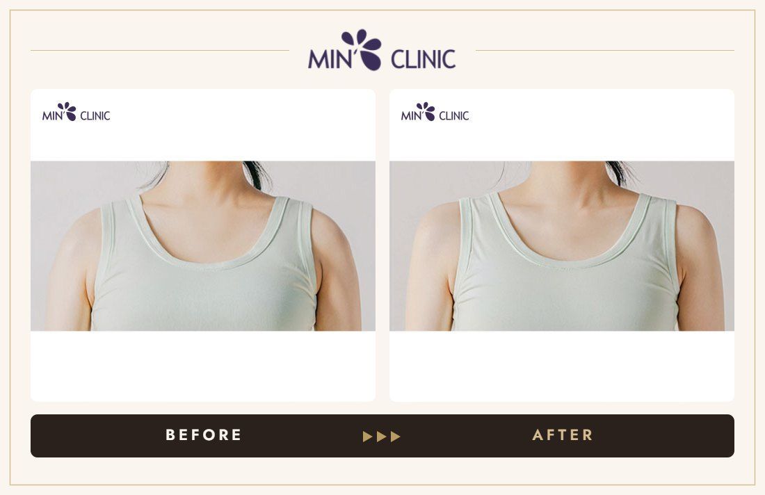 Shoulder filler before and after, case 2 – MIN Clinic Seoul