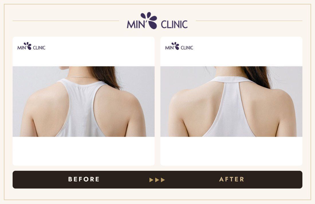 Shoulder filler before and after, case 3 – MIN Clinic Seoul