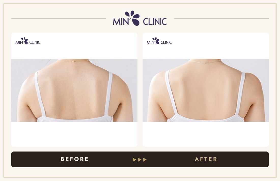 Shoulder filler before and after, case 4 – MIN Clinic Seoul