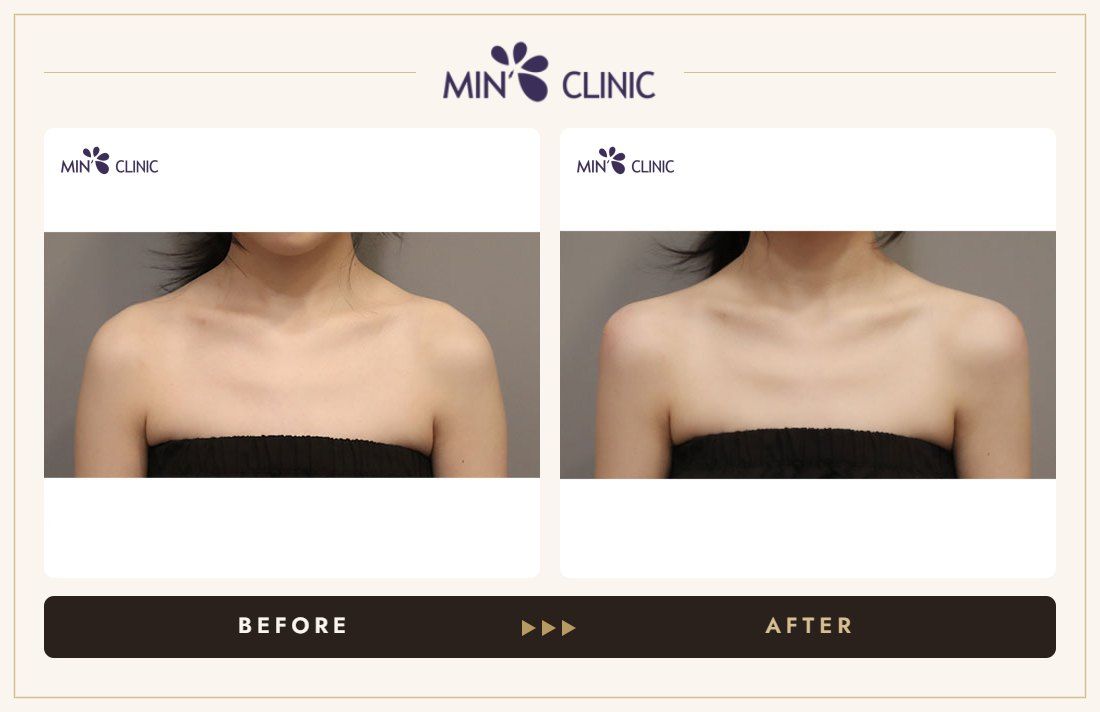 Shoulder filler before and after, case 5 – MIN Clinic Seoul