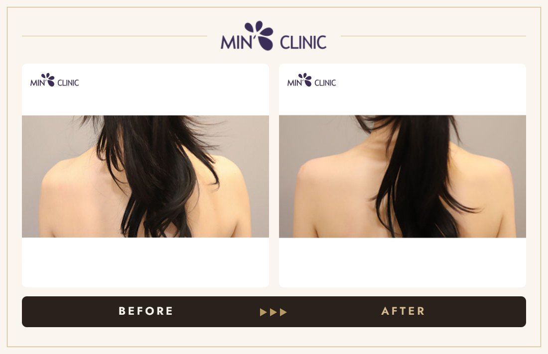 Shoulder filler before and after, case 6 – MIN Clinic Seoul