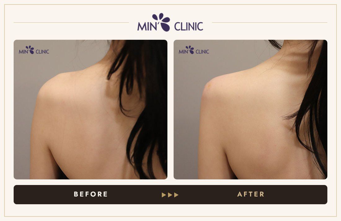 Shoulder filler before and after, case 8 – MIN Clinic Seoul