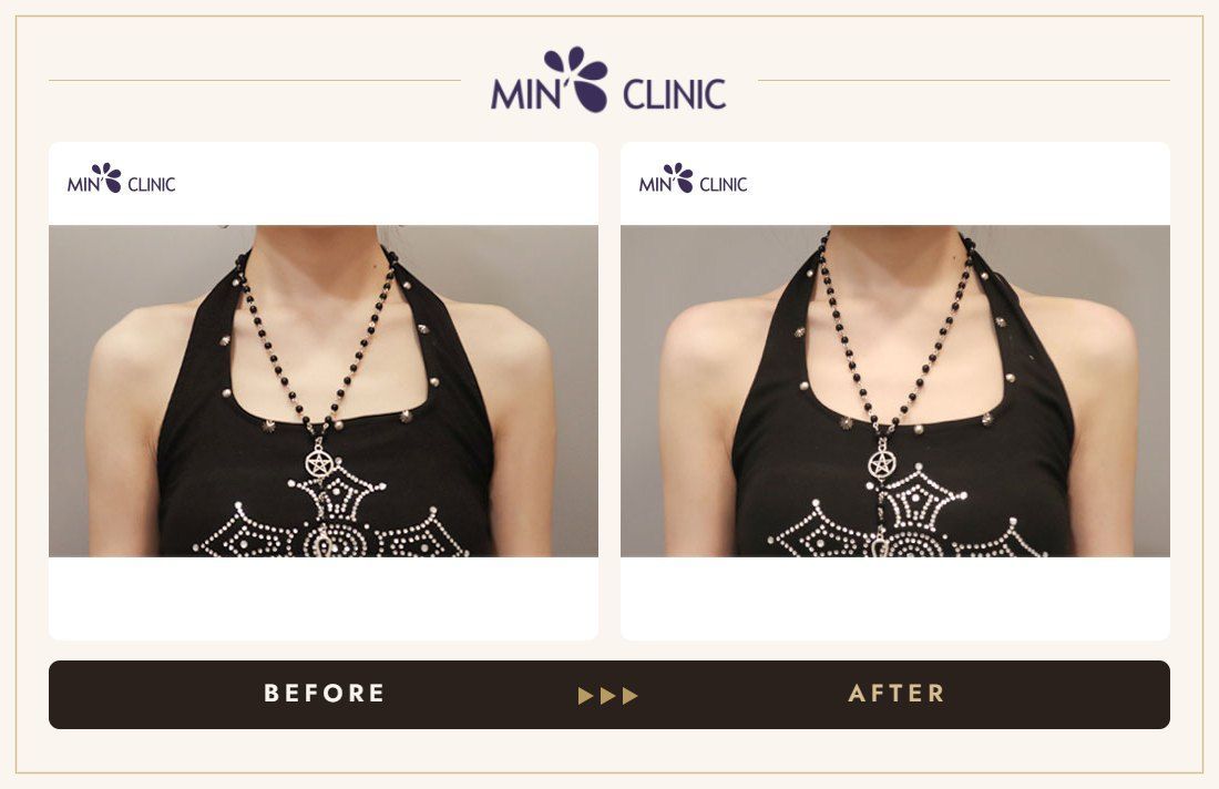 Shoulder filler before and after, case 9 – MIN Clinic Seoul
