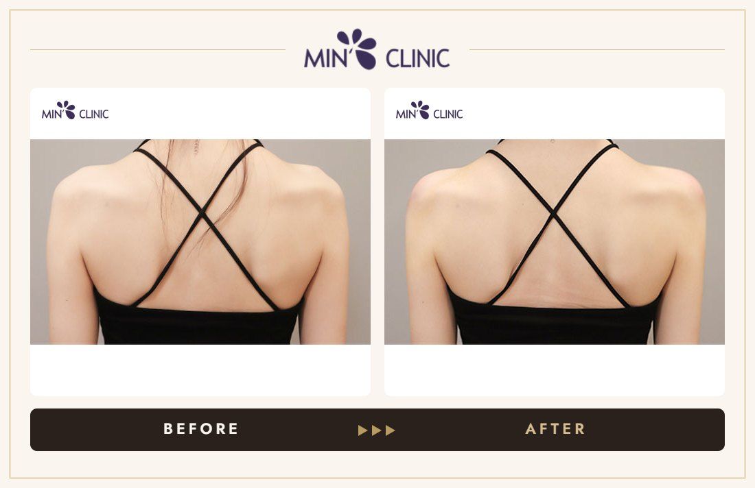 Shoulder filler before and after – MIN Clinic Gangnam, Seoul