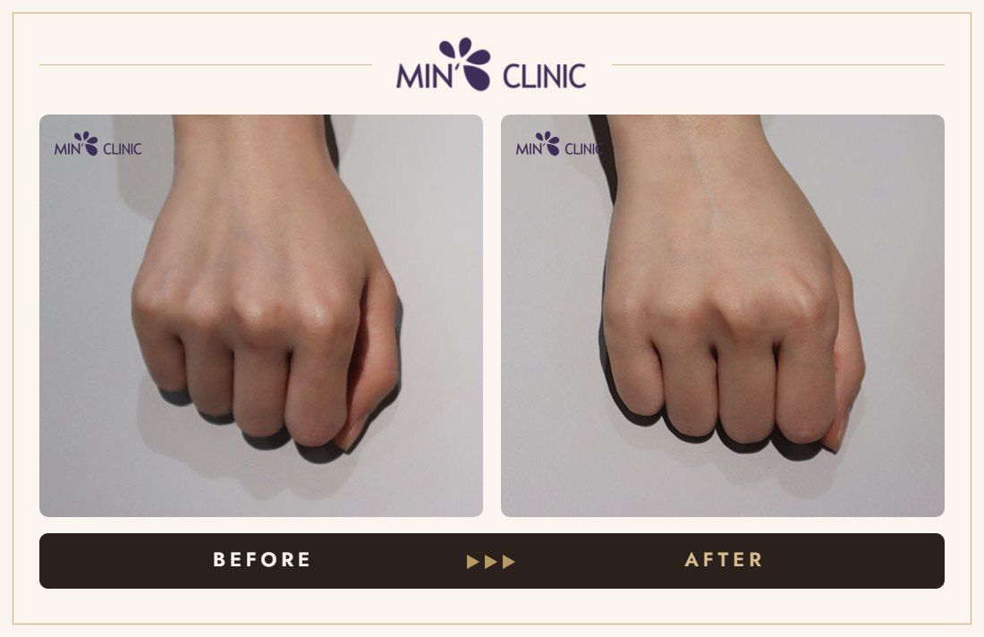 Hand filler before and after, case 1 – MIN Clinic Seoul
