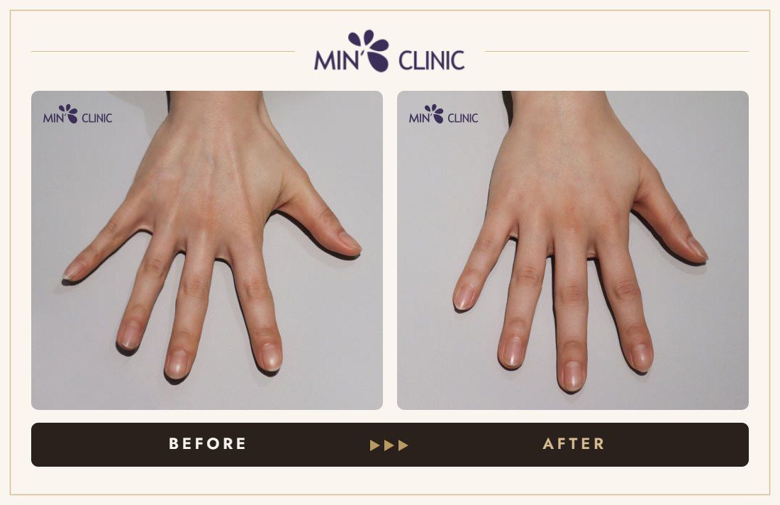 Hand filler before and after, case 2 – MIN Clinic Seoul