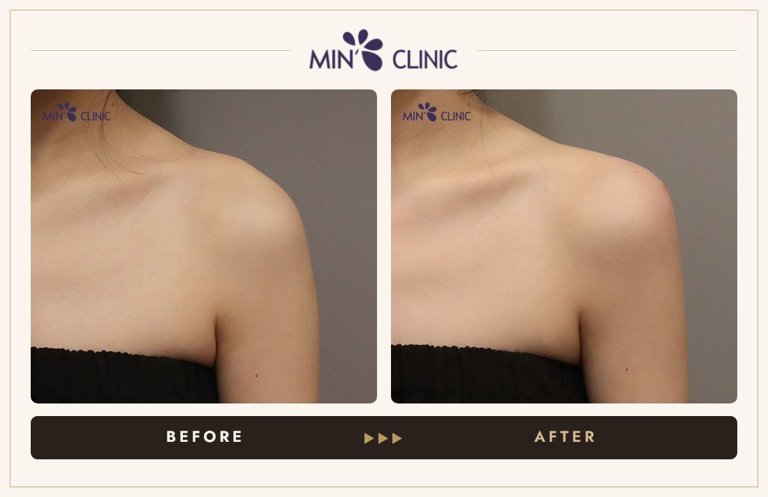 Shoulder filler before and after, case 7 – MIN Clinic Seoul