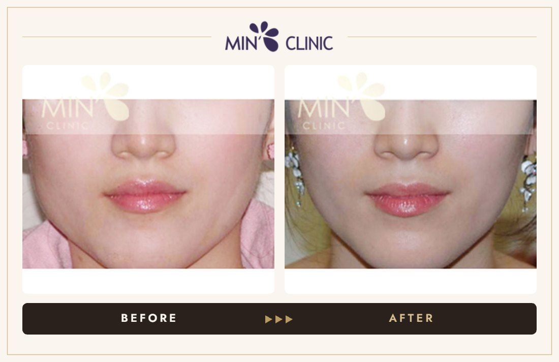 Jaw Botox before and after, case 23 – MIN Clinic Seoul