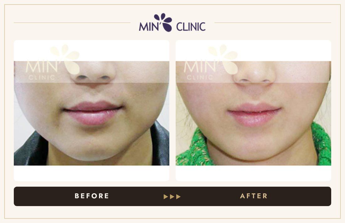 Jaw Botox before and after, case 24 – MIN Clinic Seoul