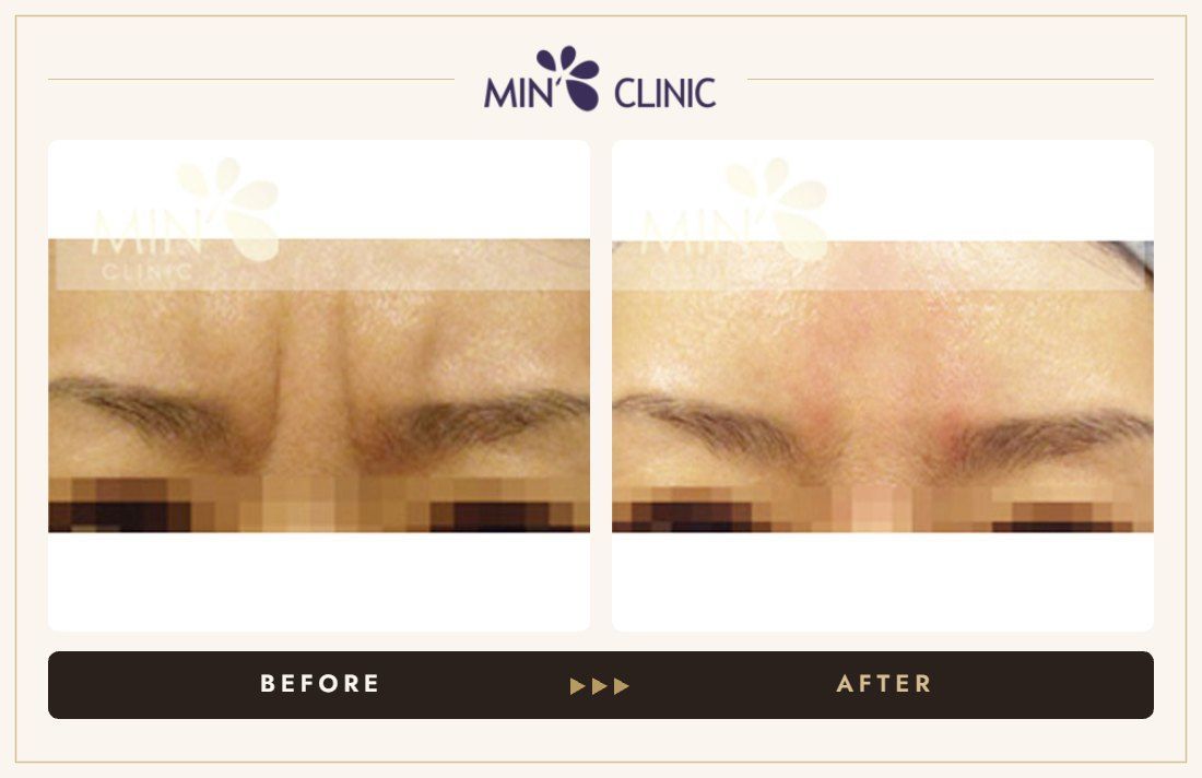 Frown-line Botox before and after, case 1 – MIN Clinic Seoul