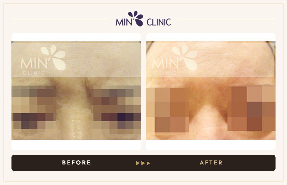Frown-line Botox before and after, case 2 – MIN Clinic Seoul
