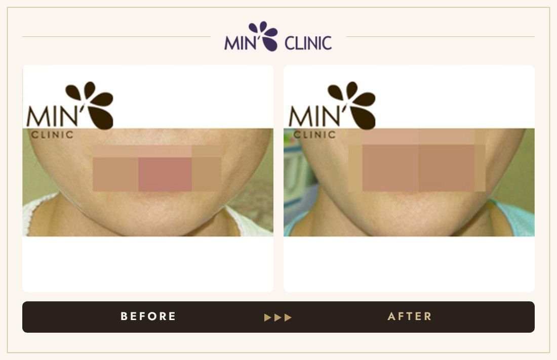 Jaw Botox before and after, case 25 – MIN Clinic Seoul