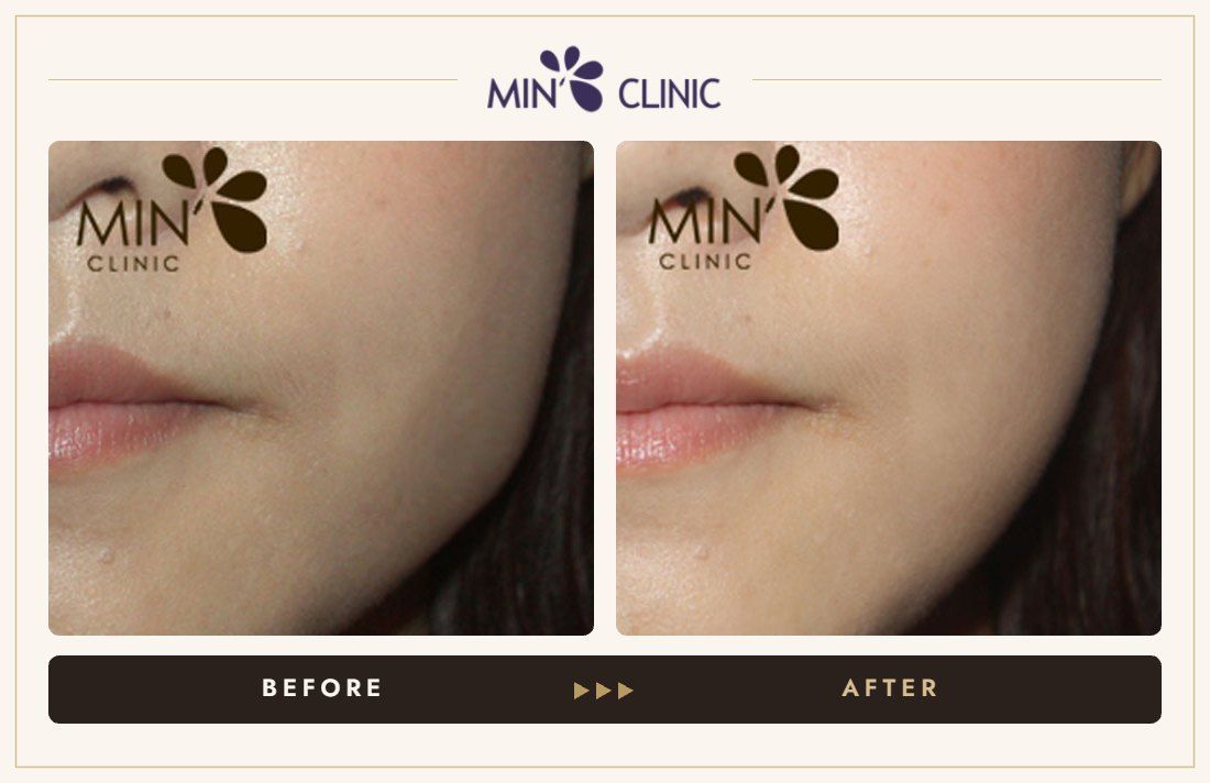 Jaw Botox before and after, case 26 – MIN Clinic Seoul
