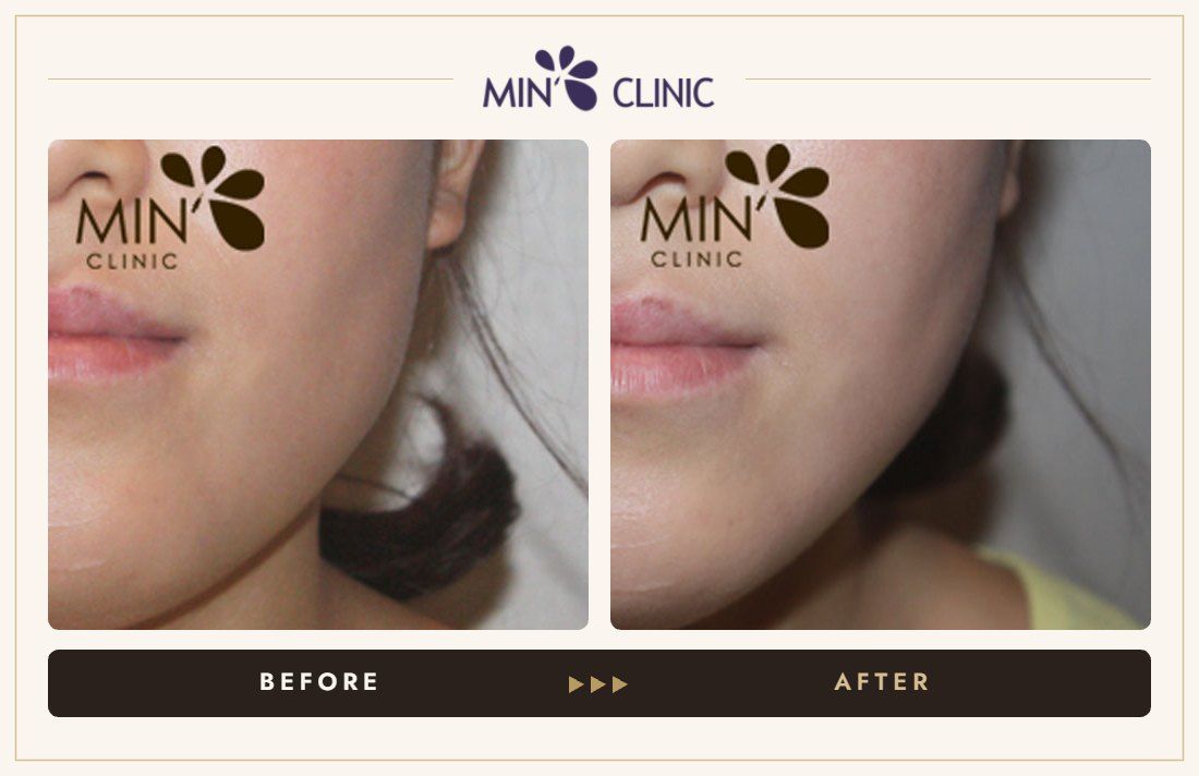 Jaw Botox before and after, case 27 – MIN Clinic Seoul