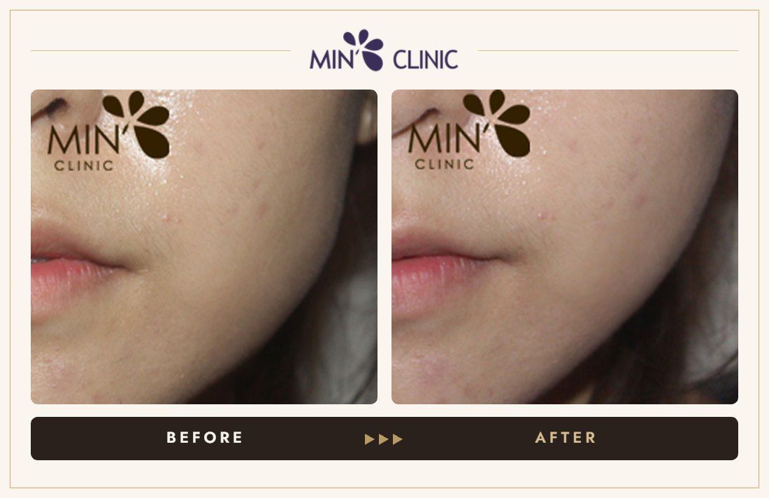 Jaw Botox before and after, case 28 – MIN Clinic Seoul