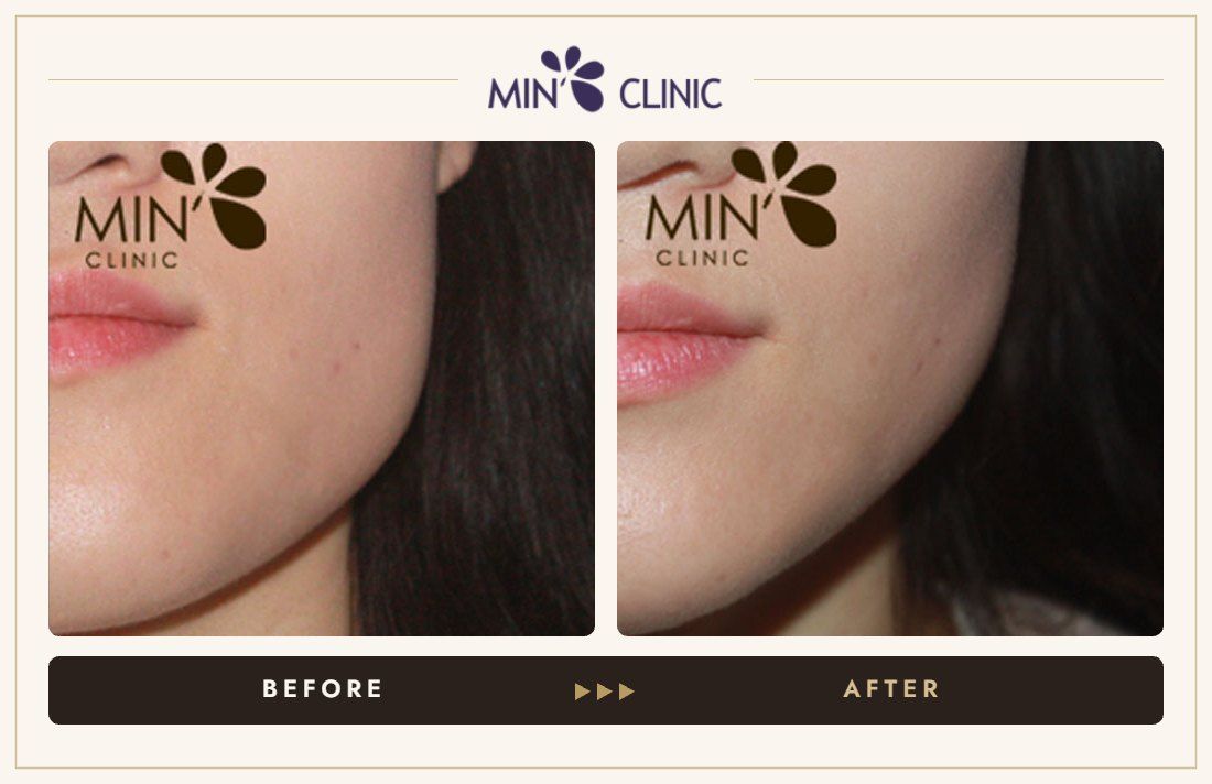Botox before and after – MIN Clinic Gangnam, Seoul