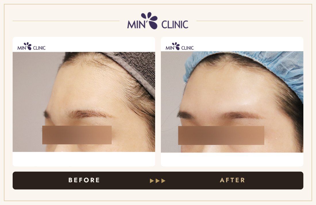 Brow bone filler before and after, case 2 – MIN Clinic Seoul