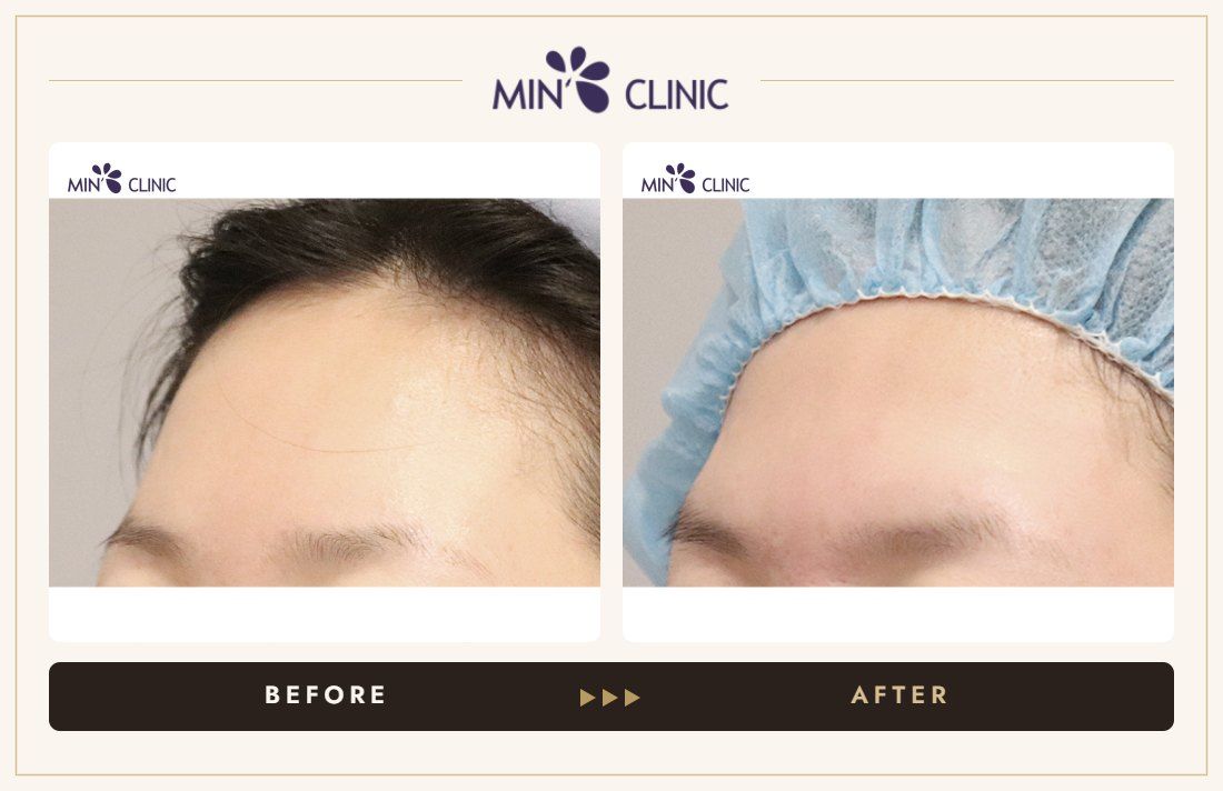 Brow bone filler before and after – MIN Clinic Gangnam, Seoul