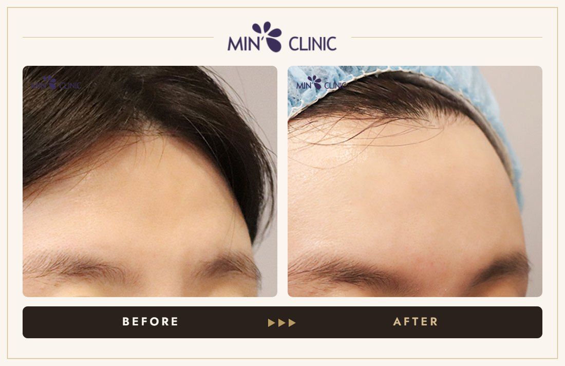 Brow bone filler before and after, case 1 – MIN Clinic Seoul