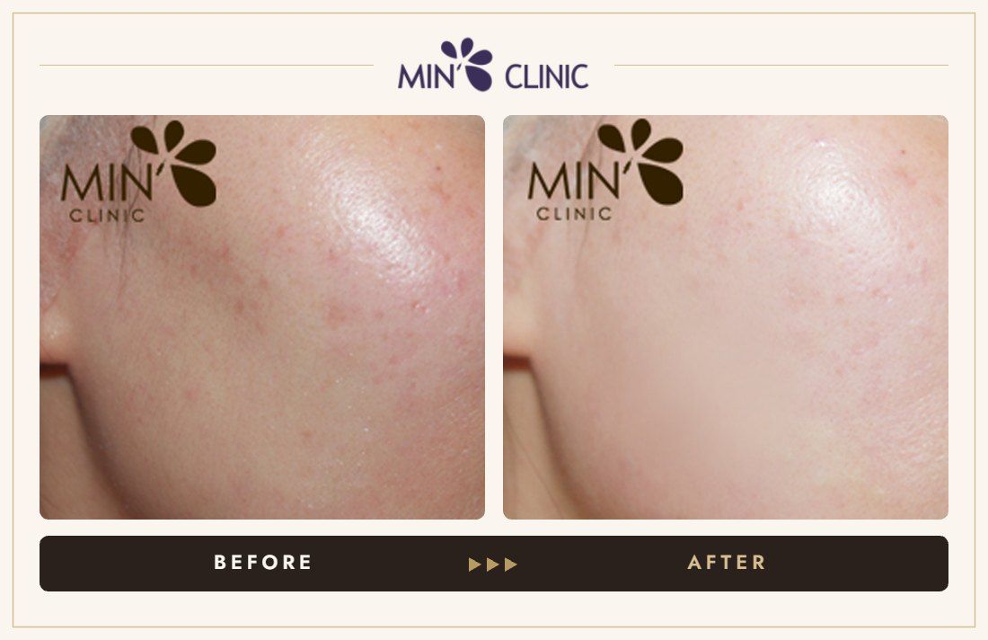 Cheek filler before and after, case 3 – MIN Clinic Seoul