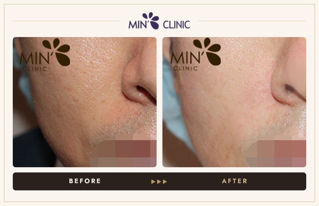 Cheek filler before and after, case 4 – MIN Clinic Seoul