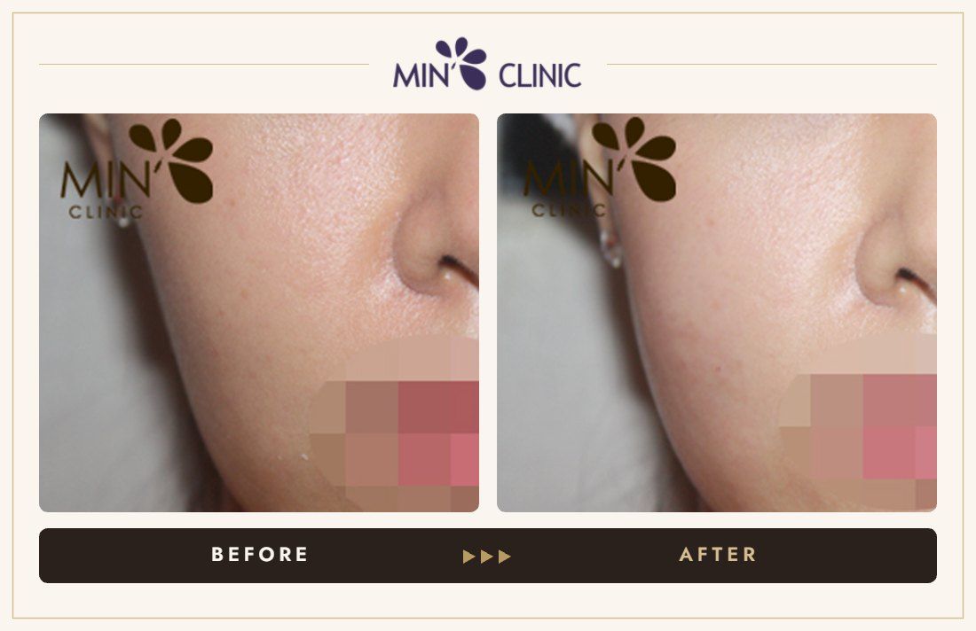 Cheek filler before and after – MIN Clinic Gangnam, Seoul